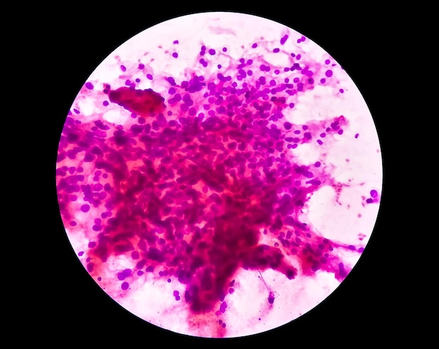 Immagine al microscopio del carcinoma a cellule chiare del rene o del cancro renale