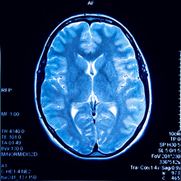 Immagine MRI del cervello