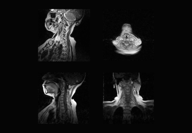 Immagini professionali per risonanza magnetica e TC della colonna vertebrale cervicale