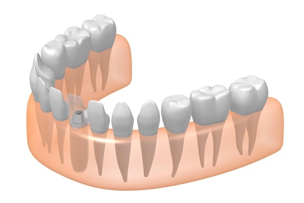 Impianto dentale altri sani e illustrazione 3D della gomma