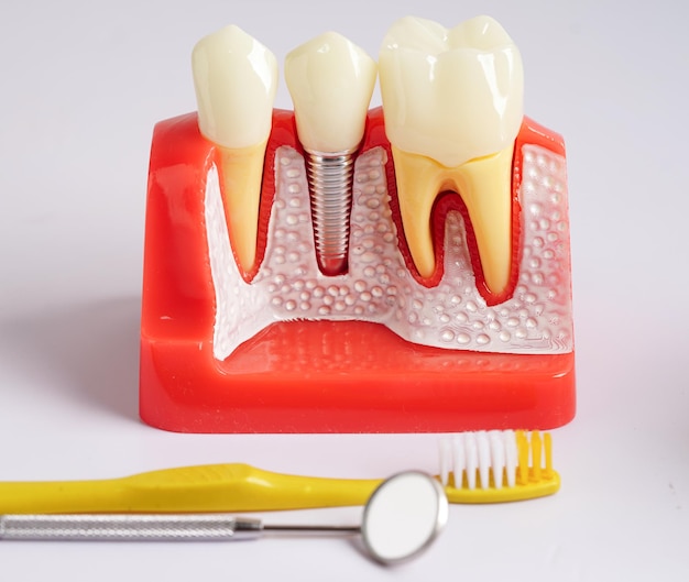 Implante dentale radici dentali artificiali nel canale radicolare della mascella di trattamento dentale malattie delle gengive denti