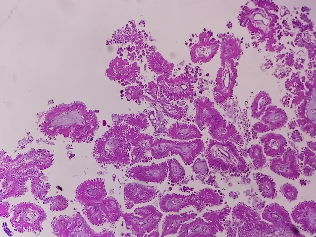 Istologia dell'adenocarcinoma papillare metastatico