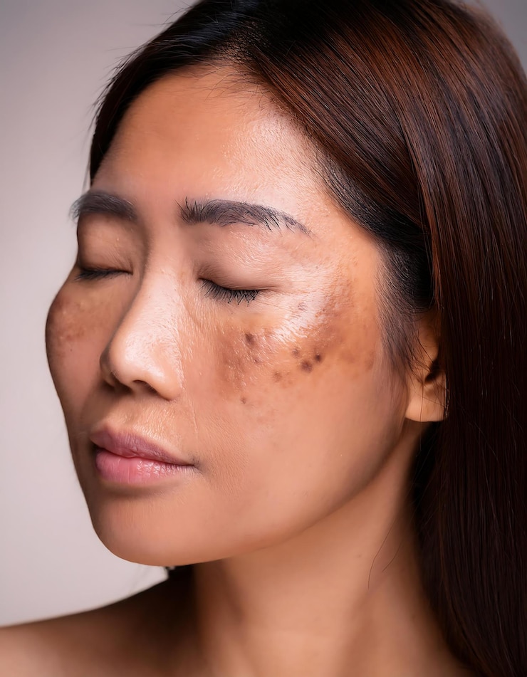 Photo kulit wanita hiperpigmentasi