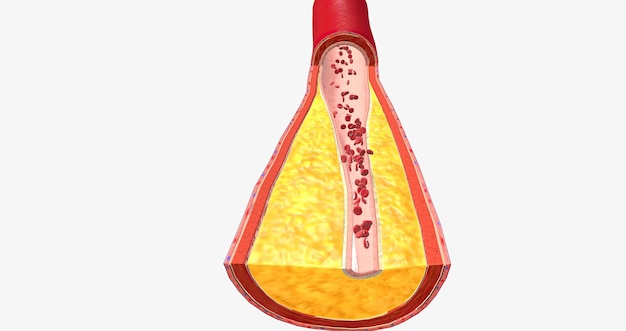 L'aterotrombosi è una malattia cardiovascolare caratterizzata dalla rottura della placca aterosclerotica e dalla formazione di coaguli