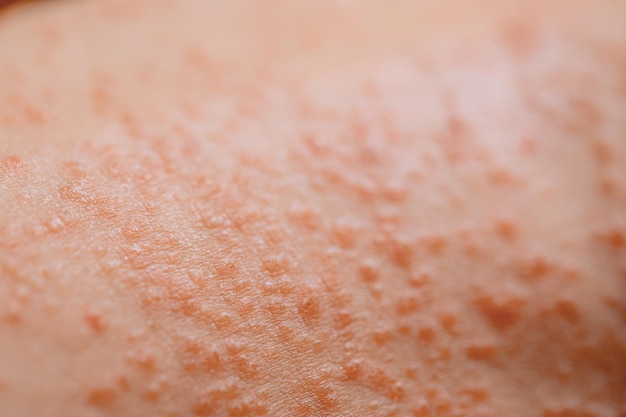 L'eruzione cutanea pigmentata sulla pelle dei bambini Un'irregolarità della pelle di porfiria nella macrofotografia