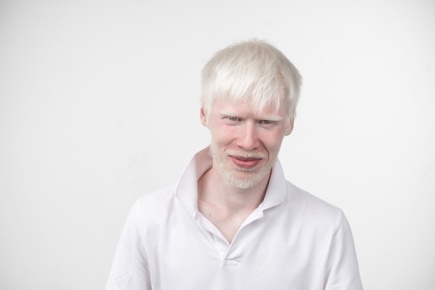 L'uomo albino di albinismo in studio vestito t-shirt isolato su uno sfondo bianco. deviazioni anormali. aspetto insolito. anormalità della pelle