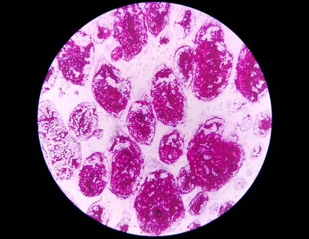 La colorazione di Gram, nota anche come analisi del metodo di Gram al microscopio, mostra cocchi gram-positivi