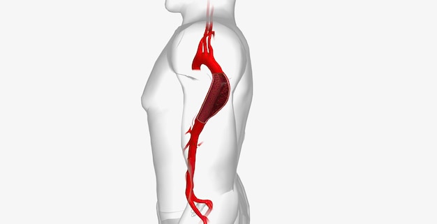 La dissezione aortica è una grave condizione cardiovascolare caratterizzata da una lacerazione nello strato interno dell'aorta