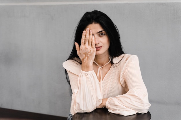 La donna georgiana con macchie di pigmentazione della vitiligine sulle mani si copre il viso con le mani Stile di vita con malattie stagionali della pelle
