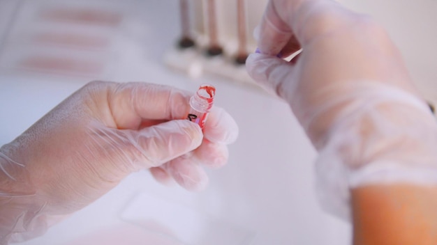 La donna lavora con il campione di sangue in laboratorio medico