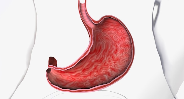 La gastrite è una condizione in cui il rivestimento dello stomaco noto come mucosa è infiammato