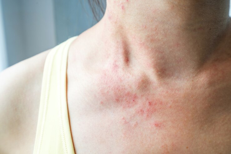 La giovane donna ha un rash cutaneo che prude al collo.