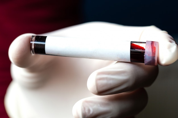 La mano con il guanto medico dello scienziato o del medico tiene la provetta con il campione di sangue e l'etichetta in bianco per il proprio testo