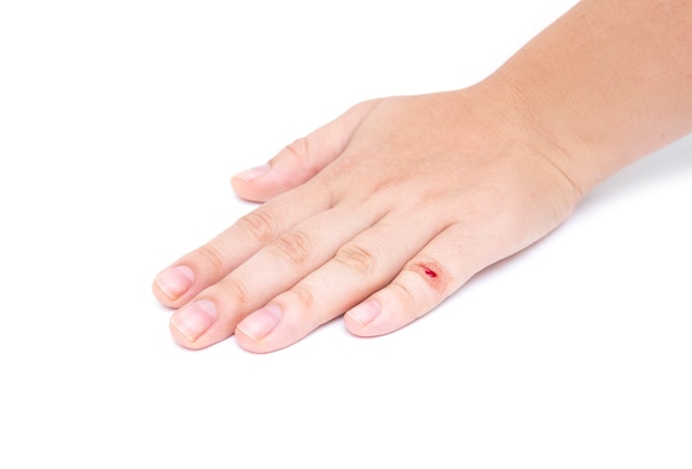 La mano della femmina con la ferita sul dito su fondo bianco