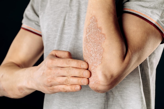 La psoriasi acuta dei gomiti è una malattia dermatologica autoimmune incurabile Una grande eruzione cutanea rossa infiammata sui gomiti Articolazioni affette da artrite psoriasica