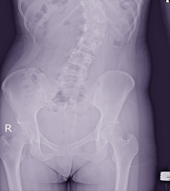 La radiografia del film di scoliosi mostra la piegatura spinale nel paziente dell&#39;adolescente. Malattia da scoliosi