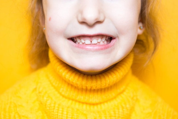 La ragazza mostra i suoi denti: morso patologico, malocclusione, overbite. Odontoiatria pediatrica e parodontologia, correzione del morso. Salute e cura dei denti, trattamento della carie, denti da latte. La mascella superiore poggia sulla gengiva.