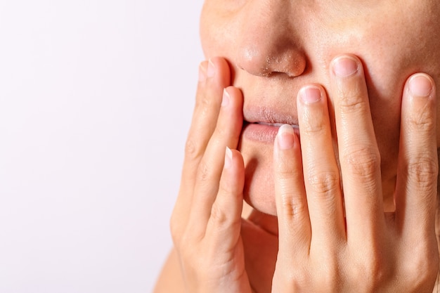 Le donne allergiche hanno il naso e le labbra asciutti dell&#39;eczema durante il primo piano della stagione invernale.