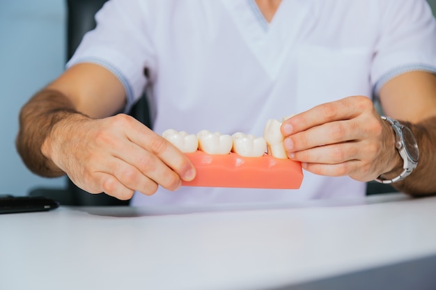 Le mani di un dentista tengono un modello di denti con un impianto dentale