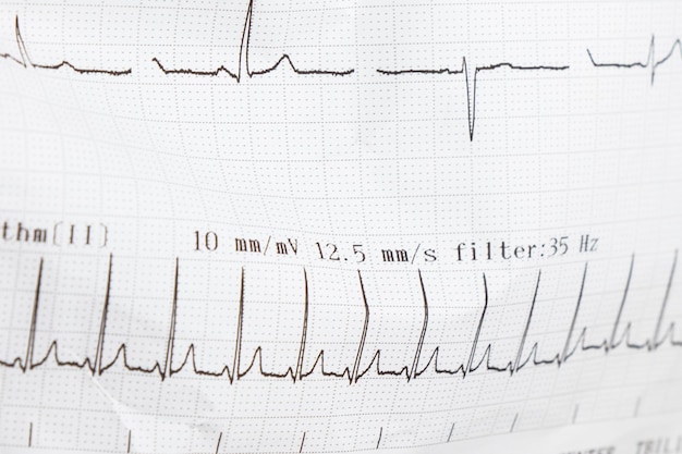 Le onde del cardiogramma del cuore battono l'ECG sulla carta