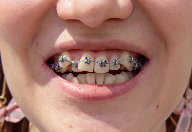 Le parentesi graffe sulla mascella superiore si trovano vicino, puoi vedere che i denti crescono storti e hanno bisogno di parentesi graffe per allineare i denti.