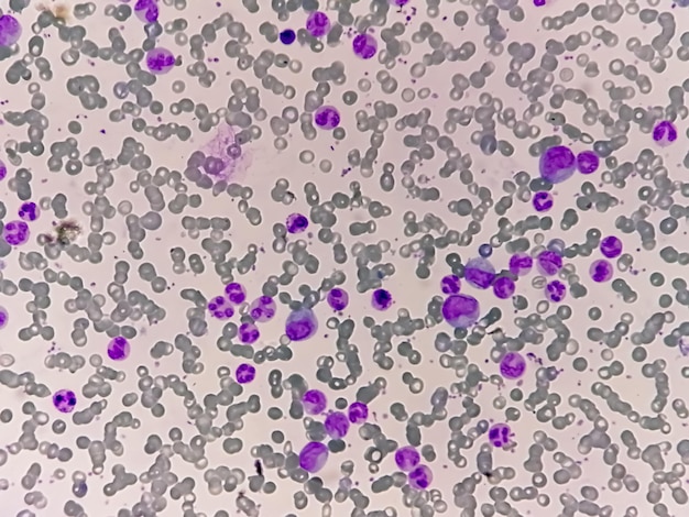 Leucemia mielocitica cronica o LMC con ematologia in fase cronica