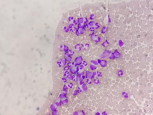 Leucemia mieloide cronica (LMC), nota anche come leucemia mieloide cronica.