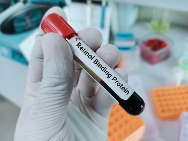 Lo scienziato tiene un campione di sangue per il test della proteina legante il retinolo.
