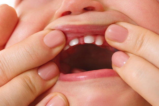 Madre che apre la bocca del suo bambino con denti decidui eruttati dai denti da latte