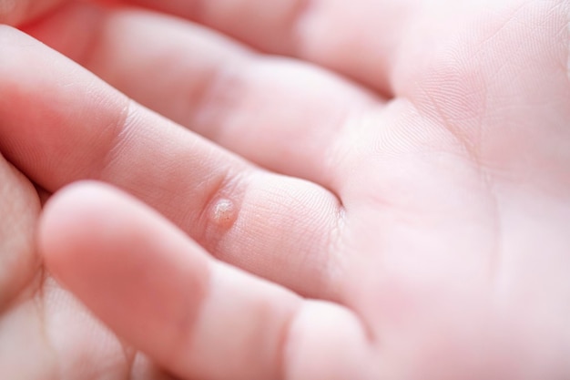 Mano del bambino con verruche Concetto di dermatologia pediatrica Papillomavirus