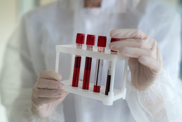 Mano del medico con una provetta con sangue prima di un test di laboratorio per il coronavirus