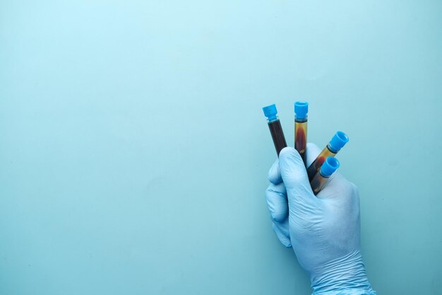 mano in guanti medicali blu tenendo la provetta del sangue