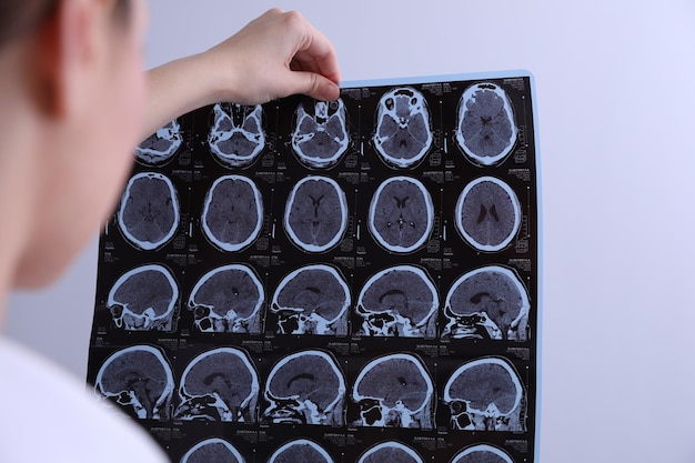 Medico che esamina le immagini MRI del paziente con sclerosi multipla in primo piano clinico