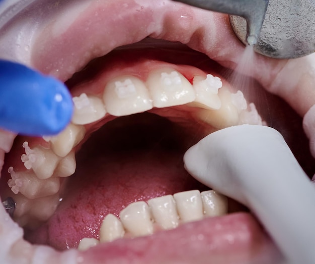 Medico che esegue la pulizia professionale dei denti nella clinica odontoiatrica