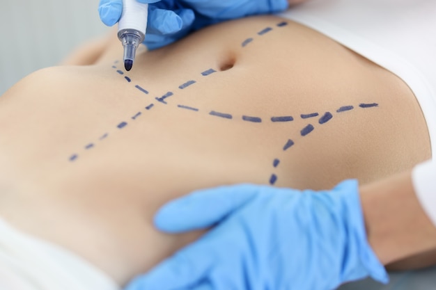 Medico chirurgo plastico che disegna segni preoperatori sulla pelle del primo piano dell'addome del paziente