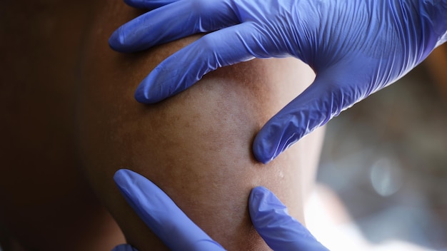 Medico in guanti di lattice controlla la pelle malsana della dermatologia del paziente maschile e la pelle del trattamento