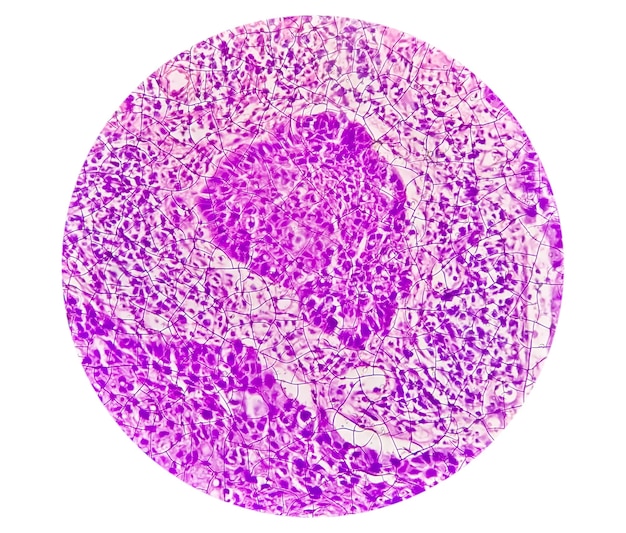 Microfotografia che mostra il carcinoma a cellule squamose della lingua di grado II. SCC orale invasivo.