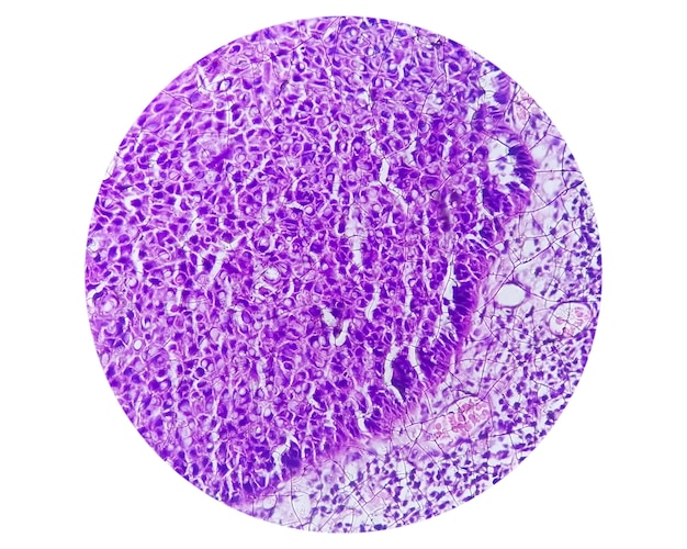 Microfotografia che mostra il carcinoma a cellule squamose della lingua di grado II. SCC orale invasivo.