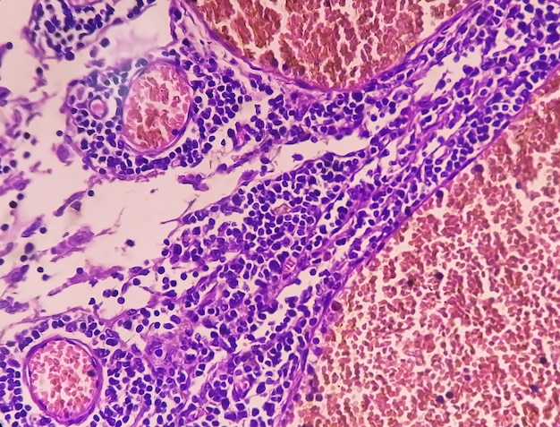 Microfotografia di adenocarcinoma dello stomaco. Adenocarcinoma gastrico.