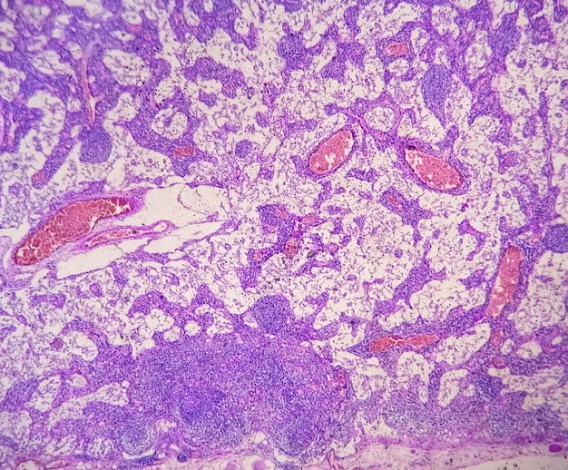 Microfotografia di adenocarcinoma dello stomaco. Adenocarcinoma gastrico.