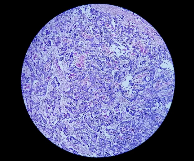 Microfotografia di adenocarcinoma di stomaco o cancro allo stomaco