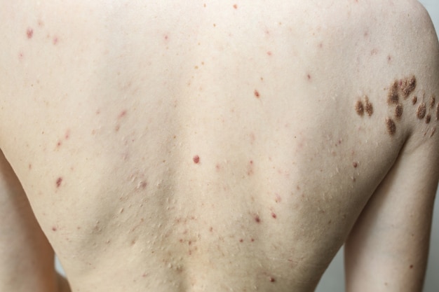 Molte voglie sulla schiena della ragazza. Foto di salute medica. Pelle grassa della donna con problemi di acne.