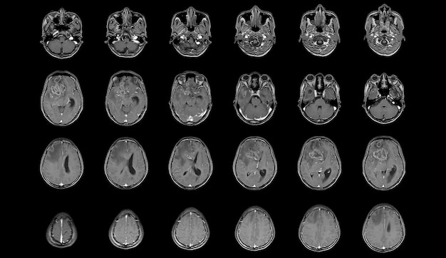 MRI Cervello Viste assiali per valutare il tumore al cervello Glioblastoma massa di isodensità delle metastasi cerebrali con un margine mal definito ed edema circostante al lobo frontale destro