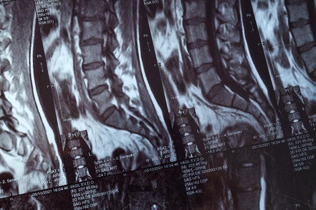 MRI o risonanza magnetica della colonna vertebrale umana Closeup