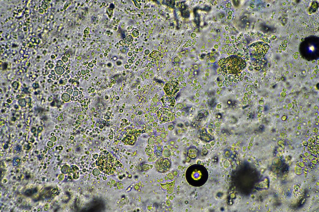 muco verde e tosse di catarro sotto il microscopio guardando le cellule dell'influenza e il muco freddo di un essere umano malato