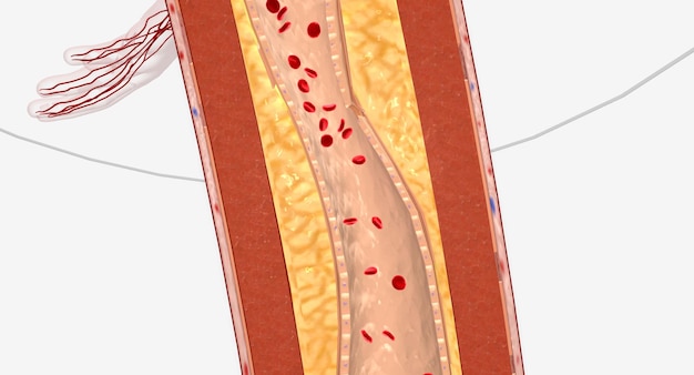 Narrowed Blood Vessel in Lower extremity