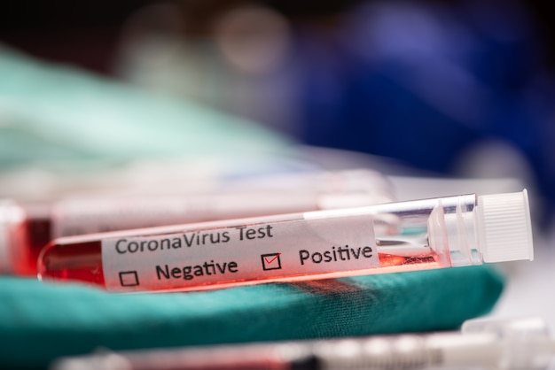 nCoV-2019. Esame del sangue del coronavirus nel test del coronavirus di laboratorio