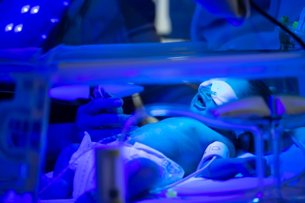 Neonato che ha un trattamento per l'ittero sotto la luce ultravioletta nell'incubatrice