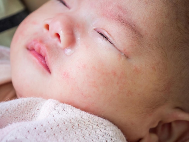 Neonato con allergia alla dermatite sul viso