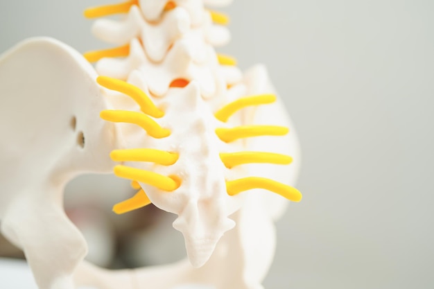 Nervo spinale e osso Colonna lombare frammento di ernia del disco spostato Modello per il trattamento medico